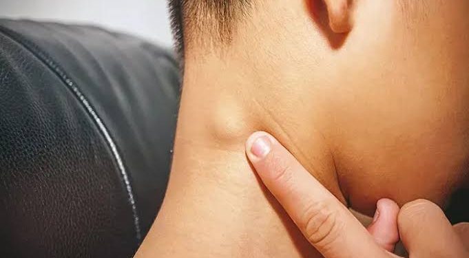Penyebab Kelenjar Getah Bening Membengkak: Faktor yang Harus Diketahui