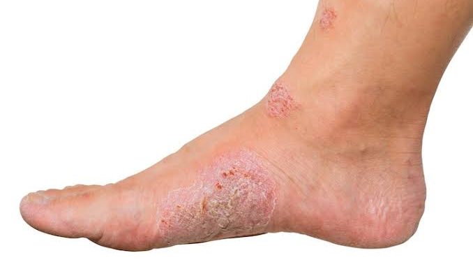Tanda-Tanda Diabetes yang Muncul di Kaki: Waspadai Gejalanya untuk Kesehatan yang Lebih Baik